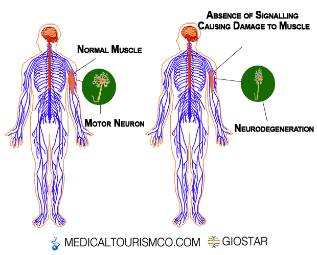 Amyotrophic-Lateral-Sclerosis