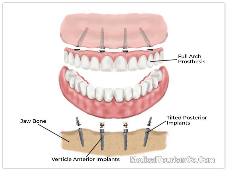 All on 4 Dental Implant