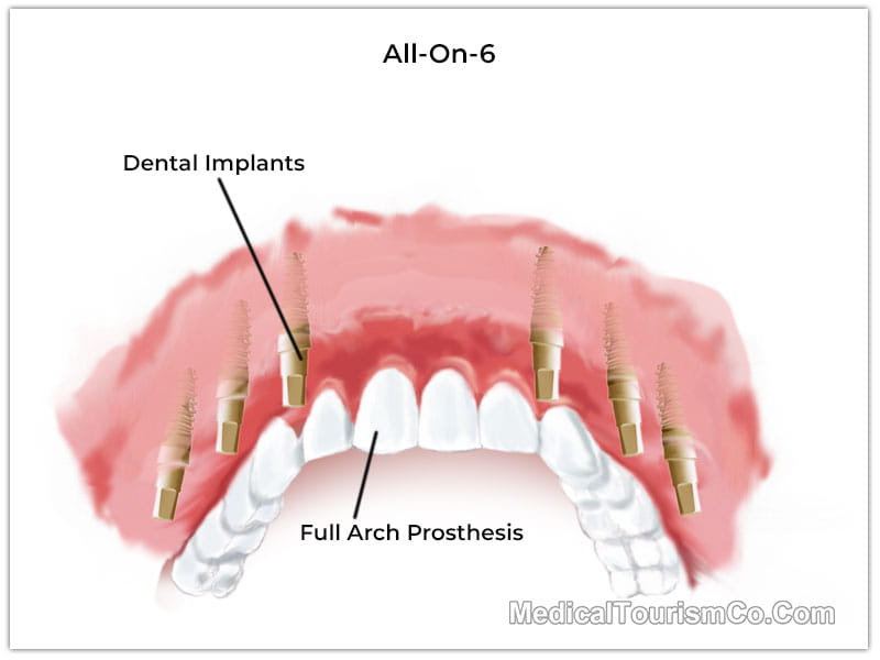 All-on-6 Dental Implants