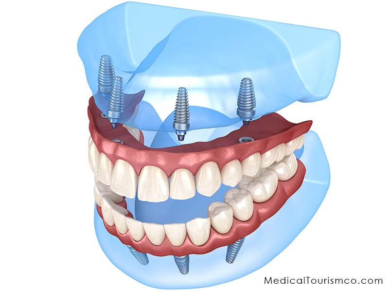 All-on-4-dental-implants