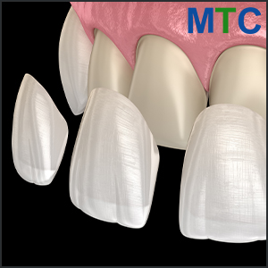 Porcelain Veneers in India