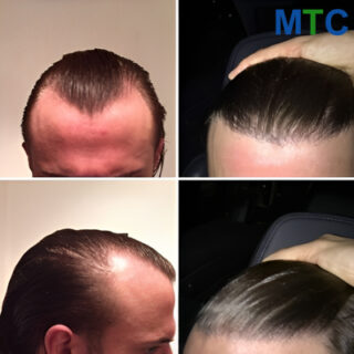 Hair Transplant Turkey