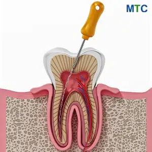 Root Canal Treatment