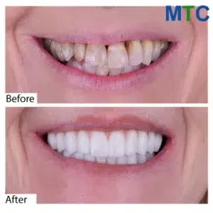 Dental Veneers in Cancun, Mexico