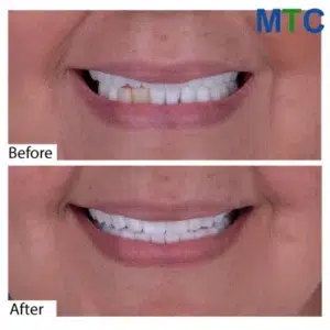 Dental Veneers in Cancun, Mexico