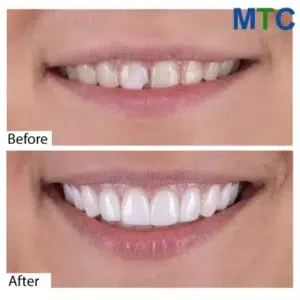 Dental Veneers in Cancun, Mexico