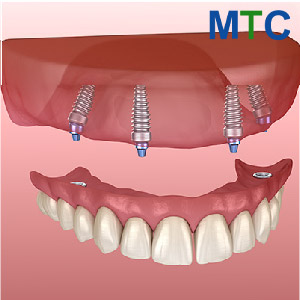 All on 4 Dental Implants