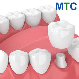 Dental Crowns in Turkey