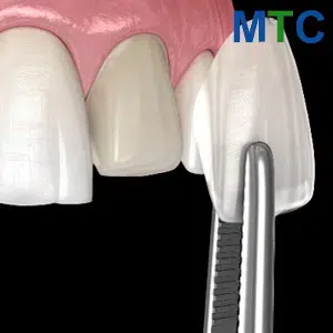 Emax Veneers