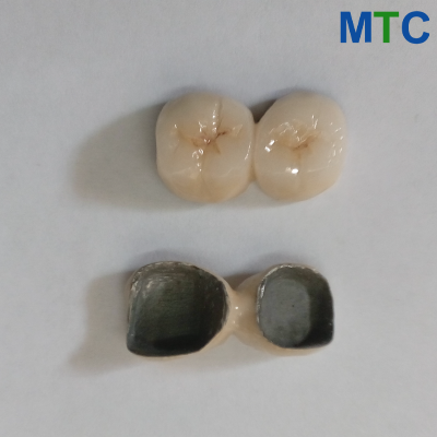 PFM dental crowns in Chandigarh, India