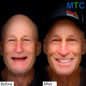 Before-After-Full-Mouth-Implants-in-Los-Algodones