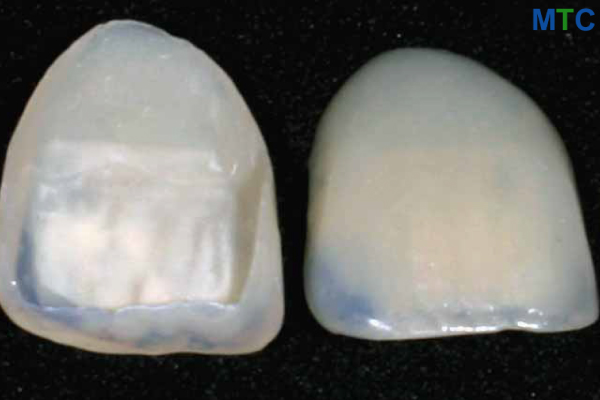 Veneers as delivered from lab