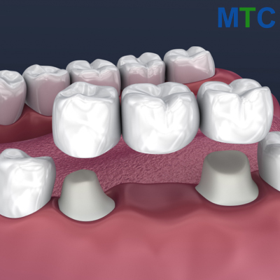 Dental Bridge