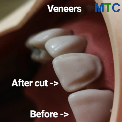 Tooth preparation for veneers