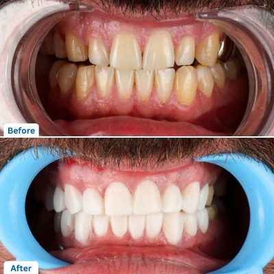 Composite Veneers