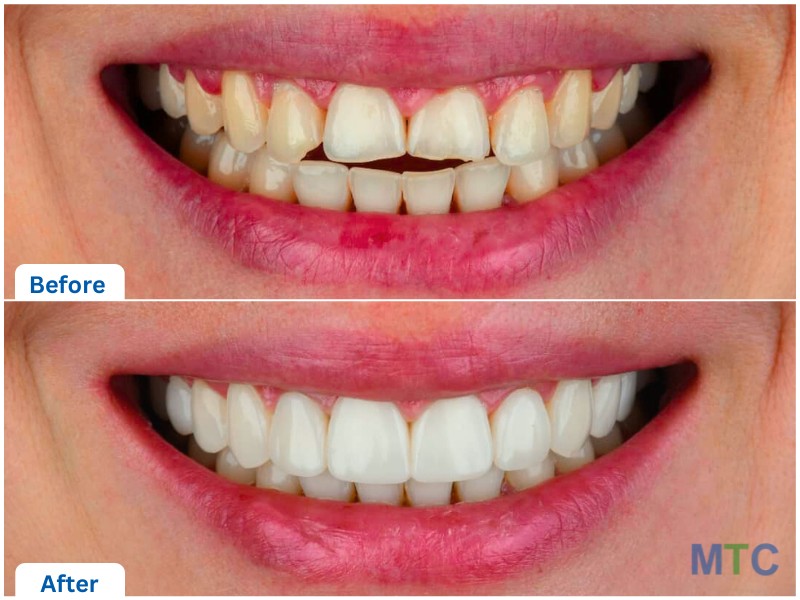 Composite Veneers