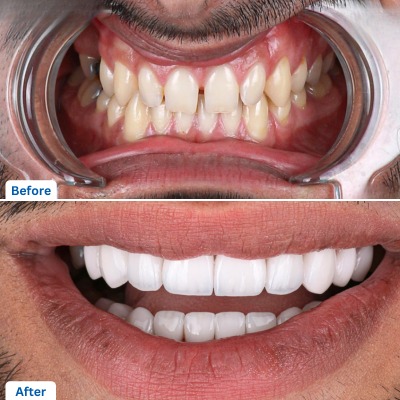 Porcelain Veneers