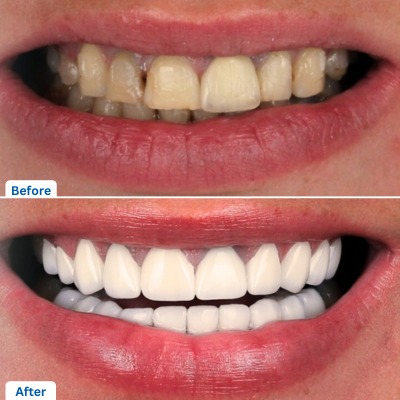 Zirconia Veneer