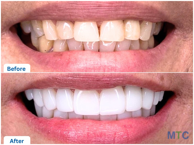 Zirconia veneers