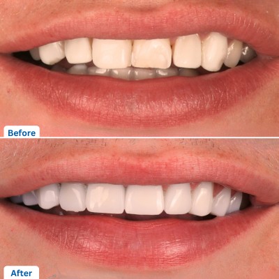 E-max Veneers