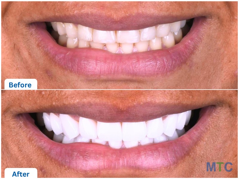 Porcelain Veneers