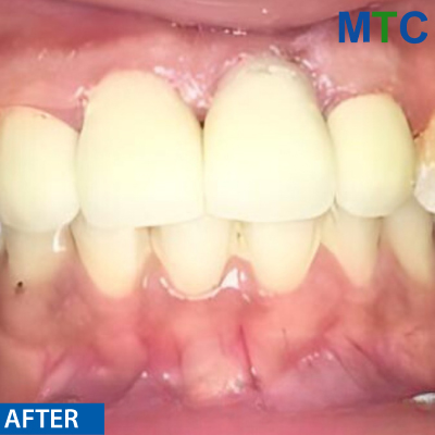 Traditional Dental Bridge - After