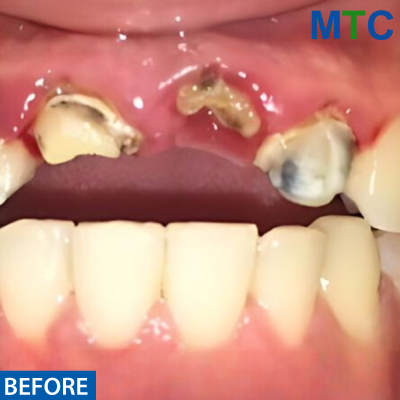 Traditional Dental Bridge - Before