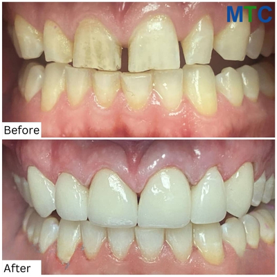 Before & After Dental Crowns in Tijuana