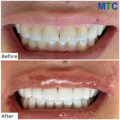 Before & After Dental Crowns in Tijuana