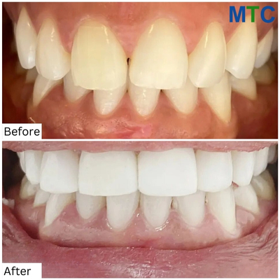 Before & After Dental Crowns in Tijuana