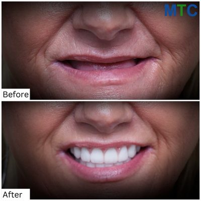 Before & After Zygomatic Dental Implants in Mexico 1