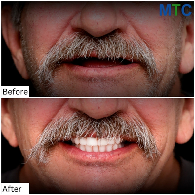 Before & After Zygomatic Dental Implants in Mexico 3