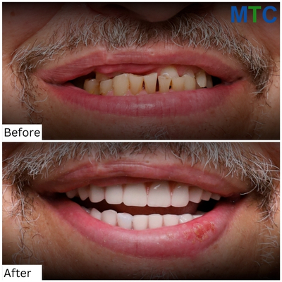 Before & After Zygomatic Dental Implants in Mexico 4