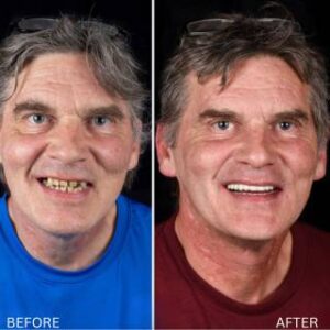 Full mouth reconstruction in Tijuana, Mexico