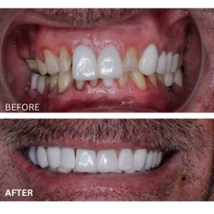 Full mouth reconstruction in Tijuana, Mexico