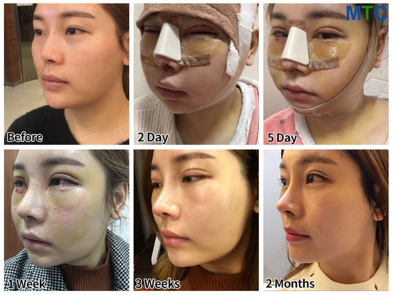 before & after images of cosmetic surgery in Seoul 