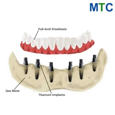 All-on-6 Implants