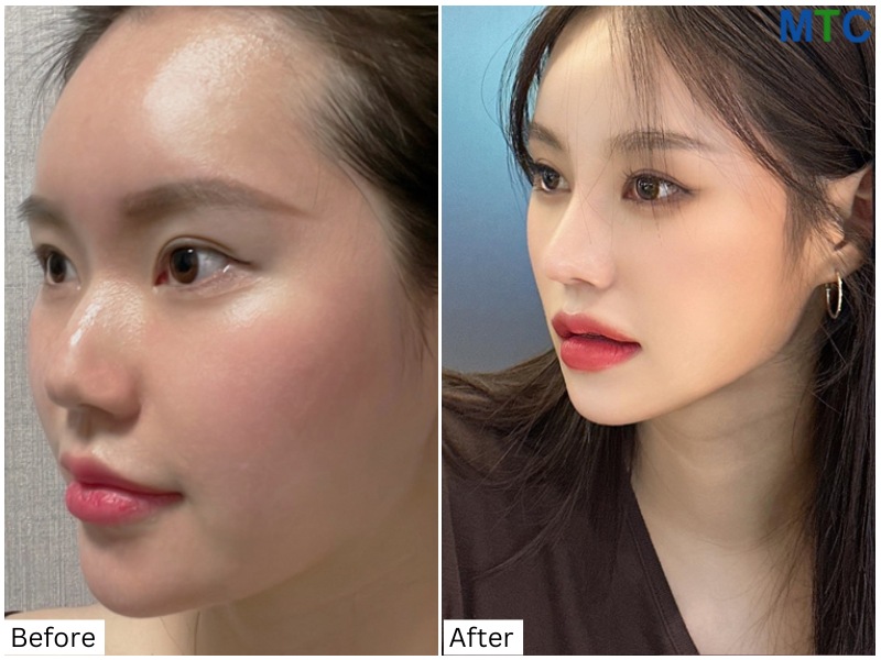 Before and after rhinoplasty in Seoul