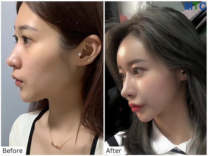 Before and after rhinoplasty in Seoul