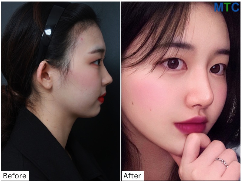 Before and after rhinoplasty in Seoul