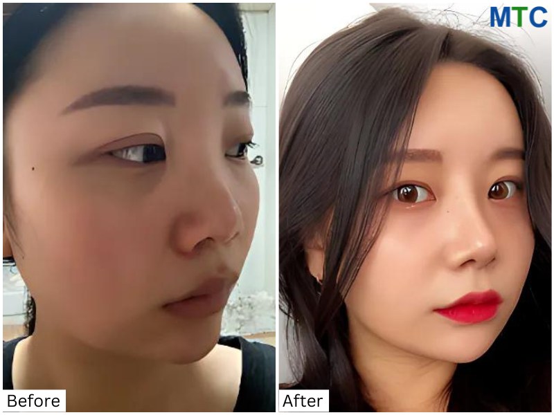 Rhinoplasty in Seoul, Korea