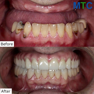 Before & After Dental Treatment in Playa del Carmen