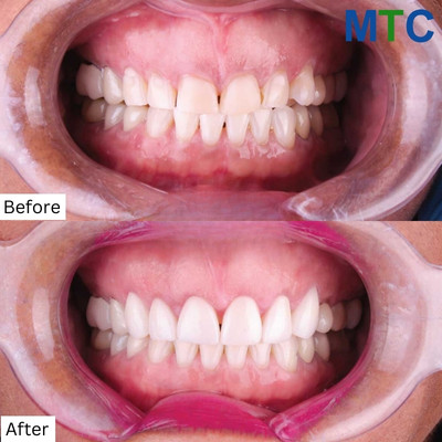 Before & After Dental Treatment in Playa del Carmen