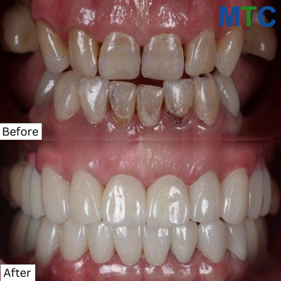 Before & After Dental Treatment in Playa del Carmen