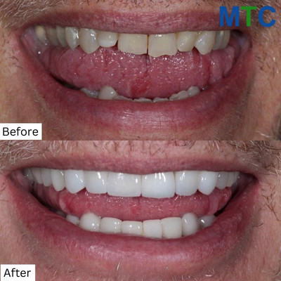 Before & After Dental Work in Playa del Carmen