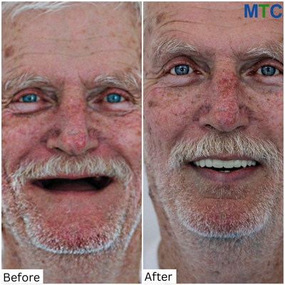 Before & After Full Mouth Implants in Los Cabos, Mexico