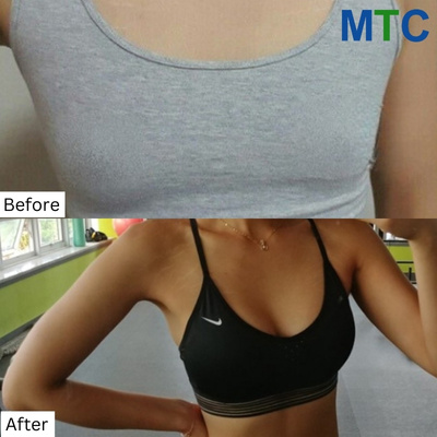 Breast Augmentation