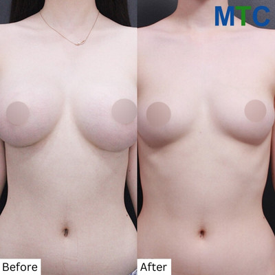 Breast Reduction Surgery