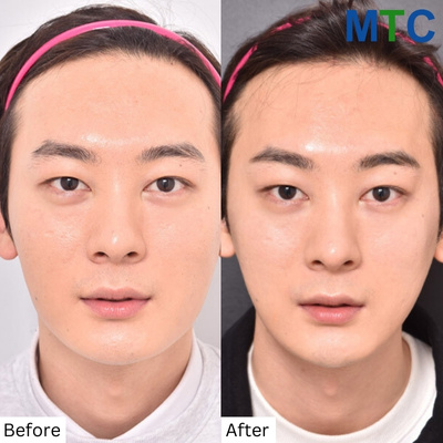 Buccal Fat Removal for Men Before and After