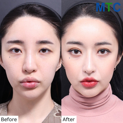 Facial Contouring